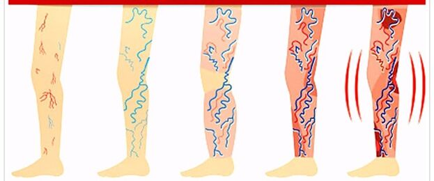 ko nedrīkst darīt ar varikozām vēnām