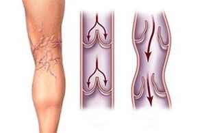 asiņu aizplūšana varikozās vēnās dažādās slimības attīstības stadijās